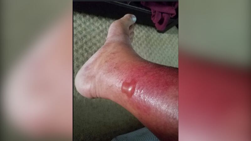 Cases of flesh-eating bacteria are on the rise.