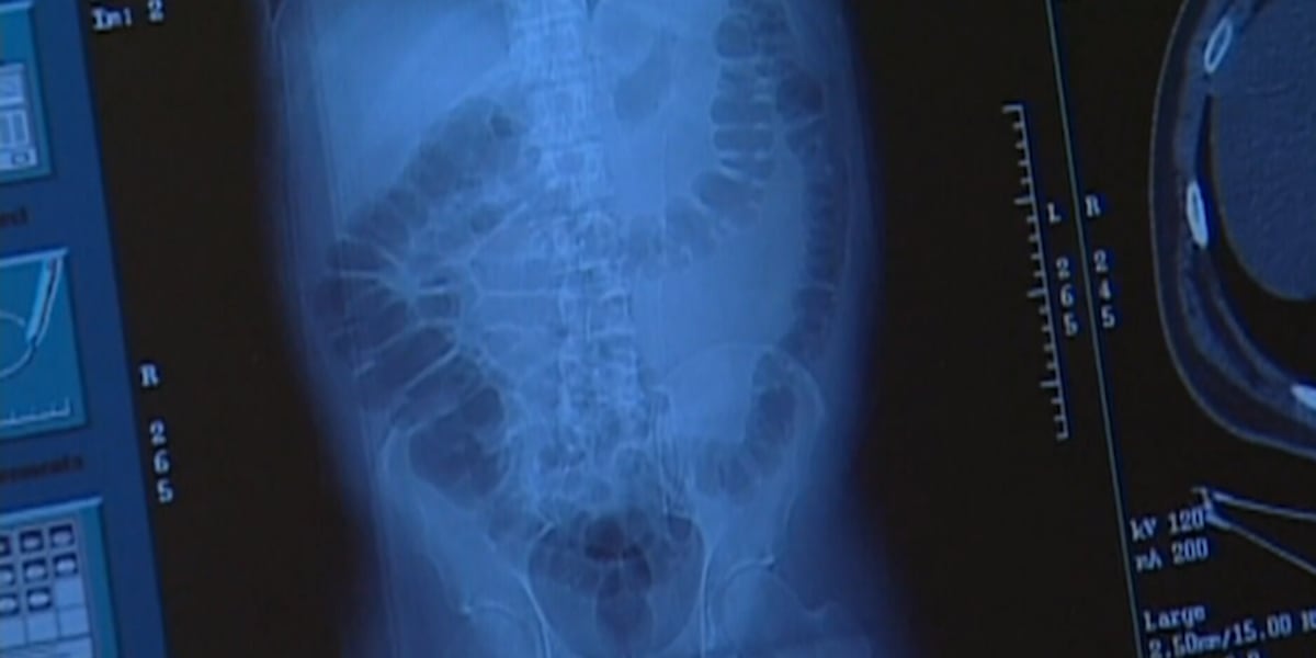 MEDICAL MONDAY: The link between colon cancer and ultraprocessed foods.